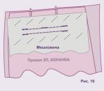 вид притачанных обтачек с изнанки